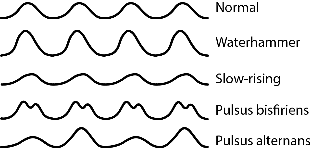 Pulsus Paradoxus Vs Pulsus Alternans