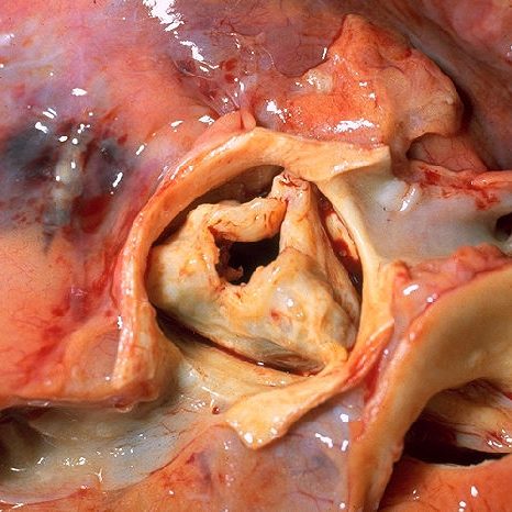 Aortic stenosis